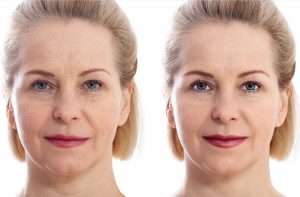 El paso del tiempo provoca flacidez, pérdida de volumen y líneas de expresión que pueden hacer que el rostro luzca cansado o envejecido.