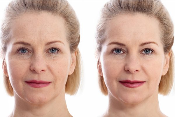 Lifting facial sin cirugía en Barcelona Y TARRAGONA