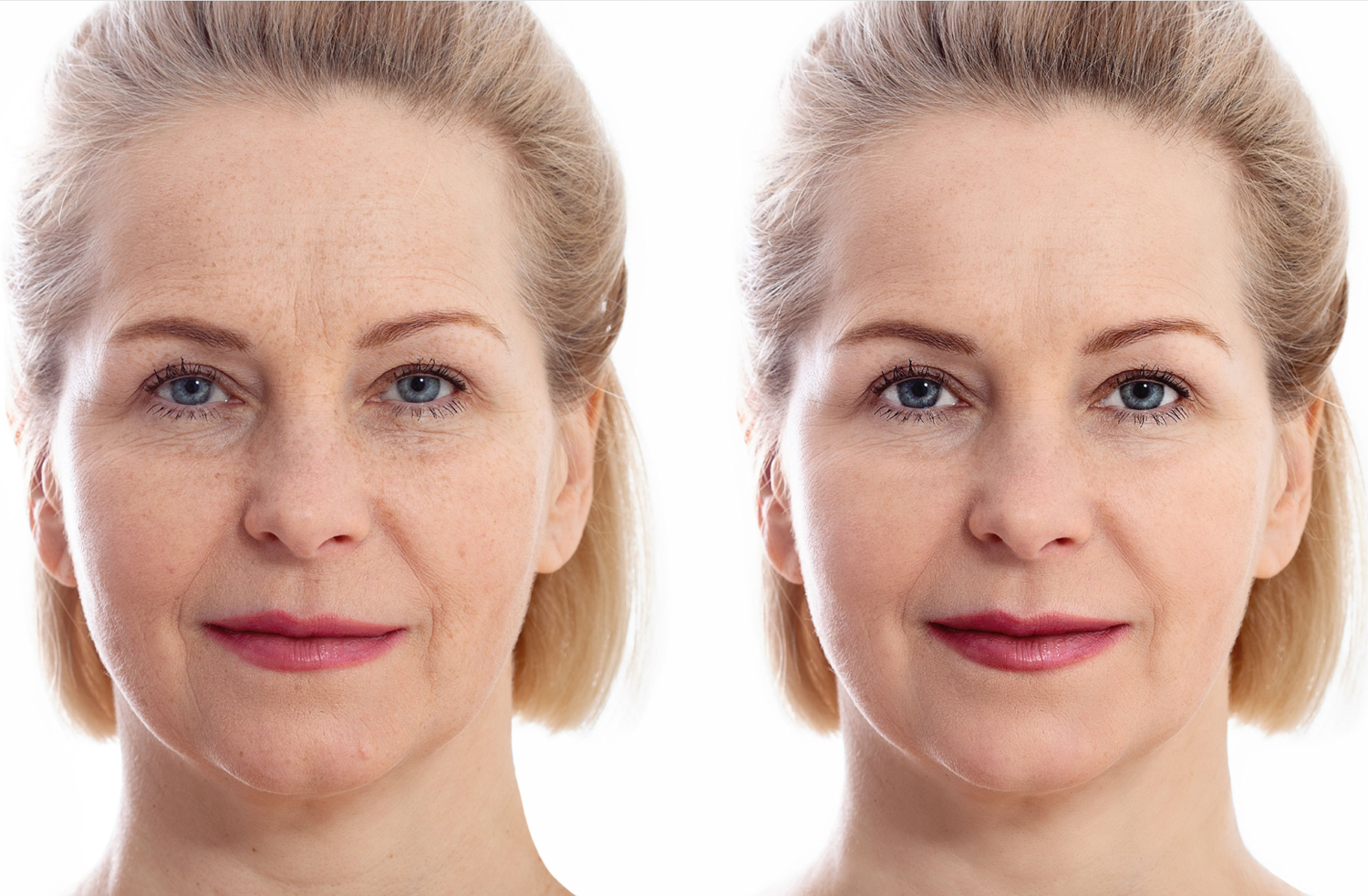 El paso del tiempo provoca flacidez, pérdida de volumen y líneas de expresión que pueden hacer que el rostro luzca cansado o envejecido.