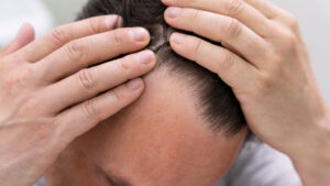 injerto capilar, tratamientos para la alopecia, calvicie