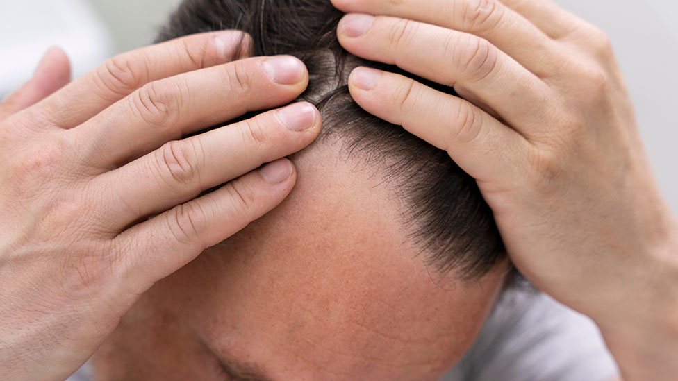 injerto capilar, tratamientos para la alopecia, calvicie