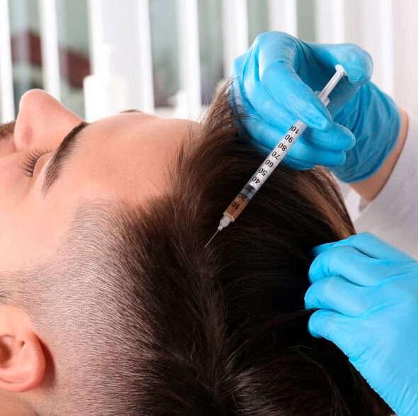 MESOTERAPIA CAPILAR