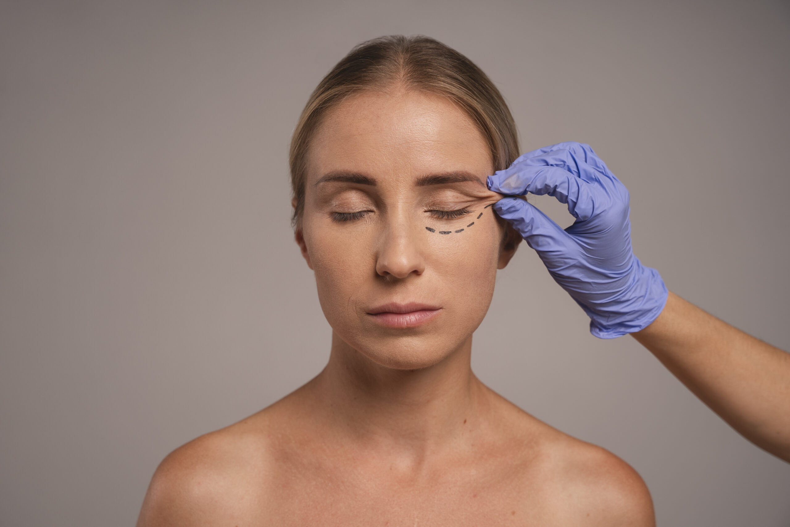 blefaroplastia en Barcelona y Tarragona