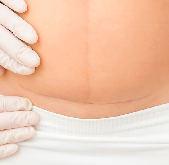 Cicatrices en zona íntima