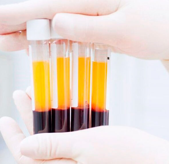 Mesoterapia plaquetaria o infiltración de plasma rico en plaquetas (PRP) vulvo-vaginal