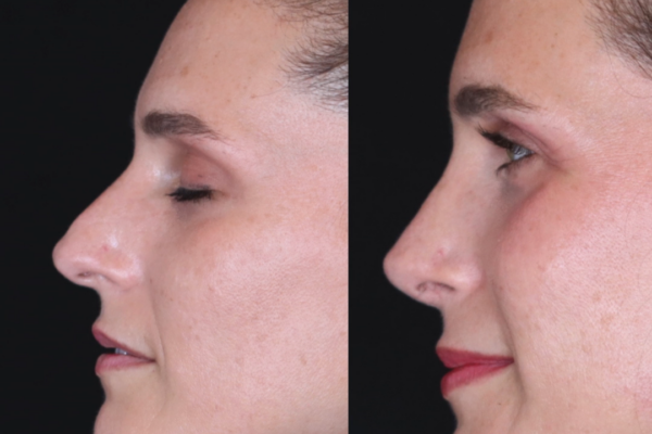 Rinoplastia ultrasónica: la técnica más avanzada para una nariz natural